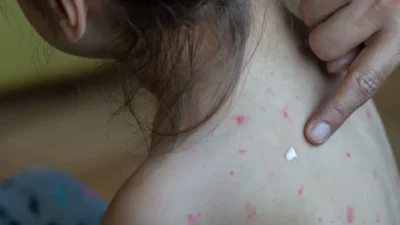 Kanada hükümeti, Ekim 2024’ten bu yana kızamık vakalarının ülke genelinde