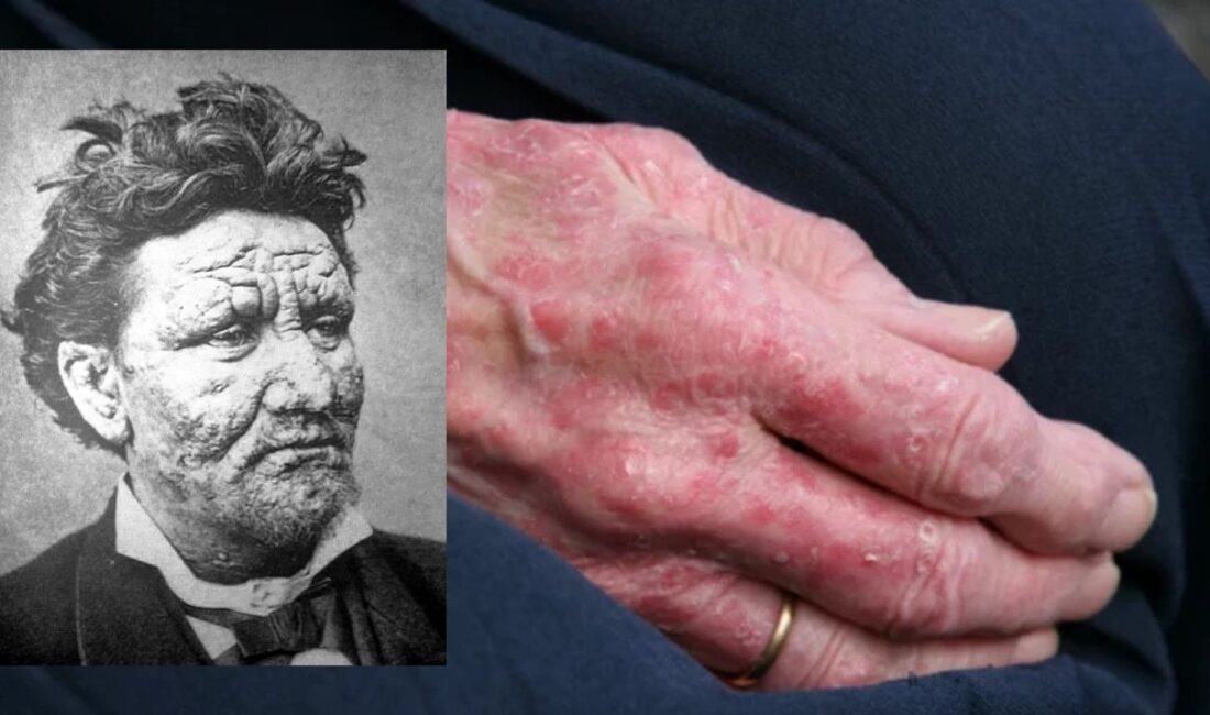 40 yıl aradan sonra ilk kez rastlanan hastalık, bölgeyi harekete