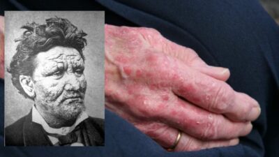 40 yıl aradan sonra ilk kez rastlanan hastalık, bölgeyi harekete