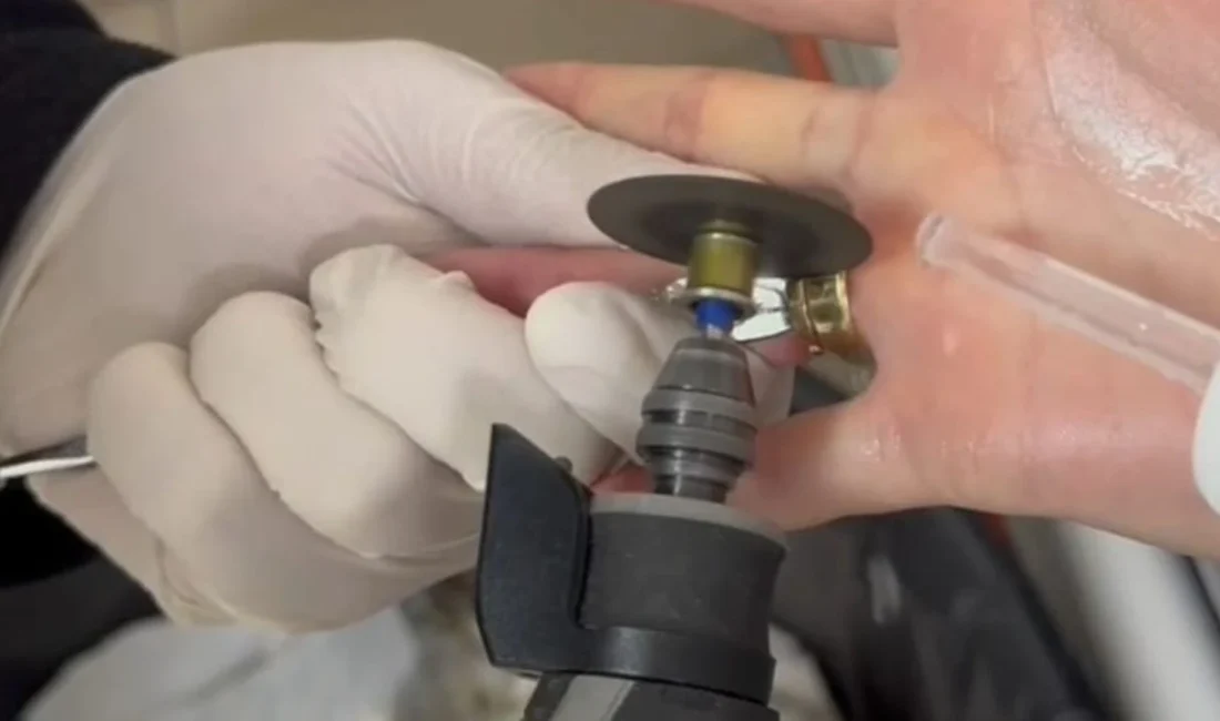 Parmağına sıkışan iki yüzüğü çıkaramayan bir kadın, şişlik ve ağrı