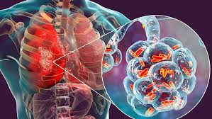 Afyonkarahisar İl Sağlık Müdürlüğü, akciğerlerde ciddi enfeksiyonlara yol açan lejyoner