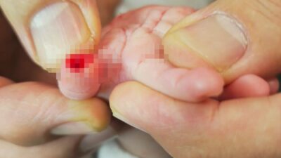 Hatay'da devlet hastanesinde tedavi gören 5 aylık Hicran bebeğin başına