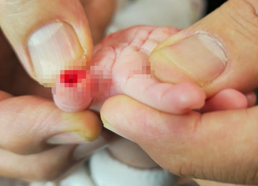 Hatay'da devlet hastanesinde tedavi gören 5 aylık Hicran bebeğin başına